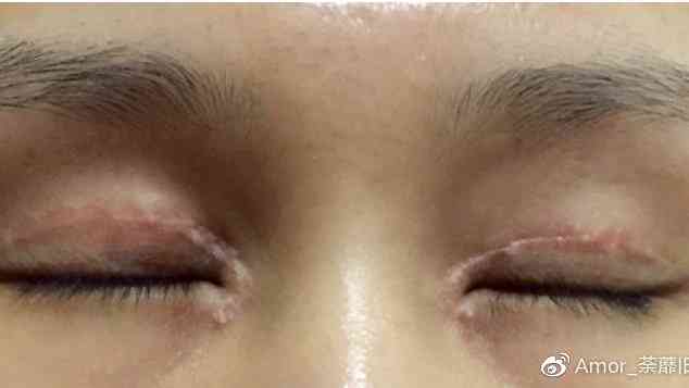 眼皮缝合手术后疤痕预防与恢复全攻略：如何减少疤痕形成及处理常见问题