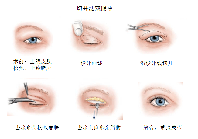 眼皮缝合手术后疤痕预防与恢复全攻略：如何减少疤痕形成及处理常见问题