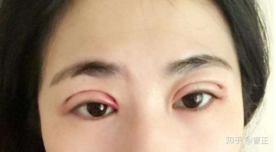 眼皮缝两针属于什么伤情鉴定：眼皮缝两针算何种伤害级别鉴定标准