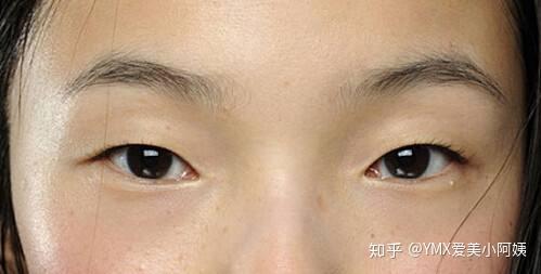 眼皮缝两针属于什么伤情鉴定：眼皮缝两针算何种伤害级别鉴定标准