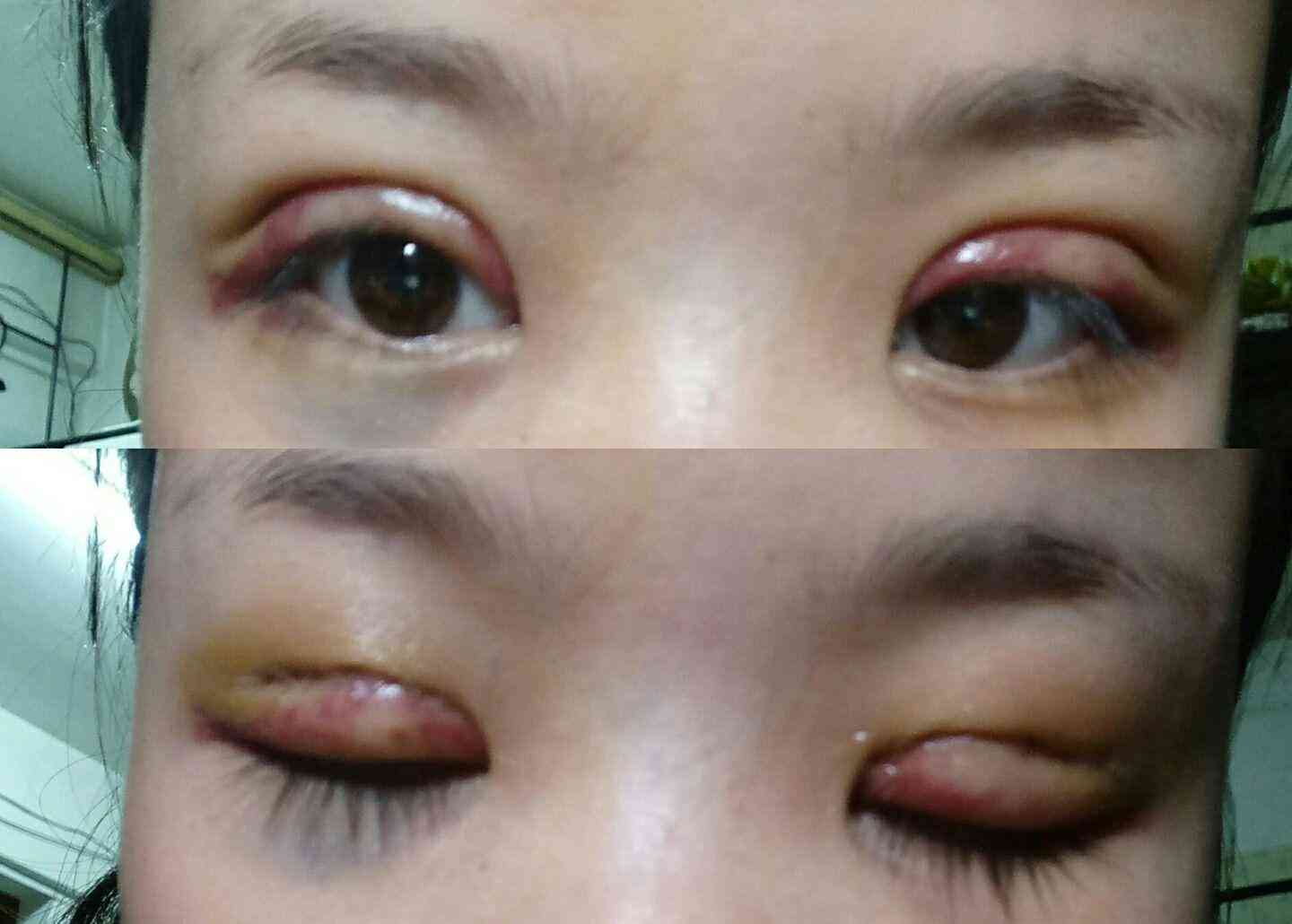 眼皮缝两针属于什么伤情鉴定：眼皮缝两针算何种伤害级别鉴定标准