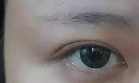 眼皮缝两针属于什么伤情鉴定：眼皮缝两针算何种伤害级别鉴定标准