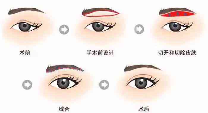 眼角微创缝合，轻松应对小伤势挑战
