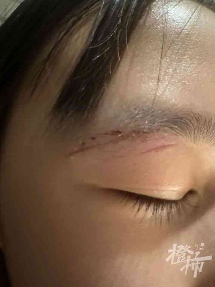 眼皮缝两针可以认定工伤吗