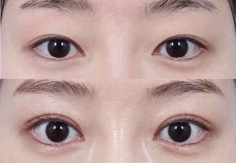 眼睛里进了铁屑怎么取出来及恢复周期多久
