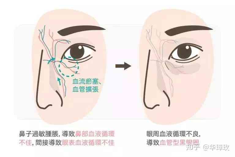 全面指南：眼部化学烧伤的急救措与后续处理方法