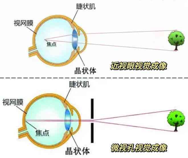 结合医学法医学视角：虹膜损伤与视力下降的眼部轻伤鉴定细则
