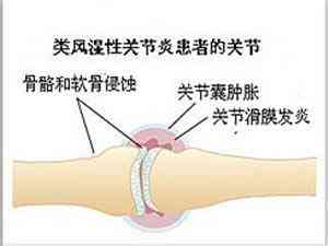类风湿关节炎能否被认定为工伤：常见疑问与解答指南
