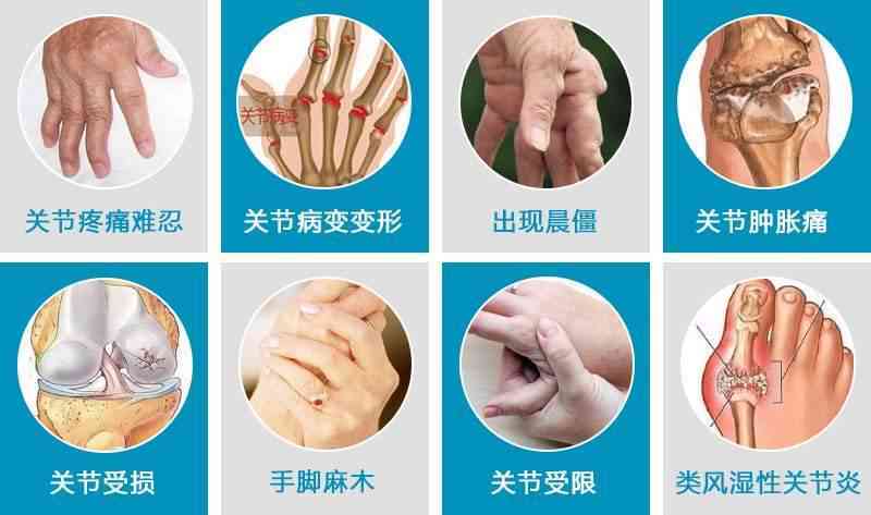 类风湿性关节炎算工伤吗：其工伤认定及伤残等级划分与职业病关系解析