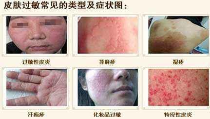 粉尘过敏症状、疾病及其健影响：全方位解析粉尘过敏相关疾病与防治方法