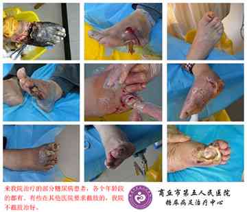 糖尿病并发症：患者截肢手术费用解析及预算估算