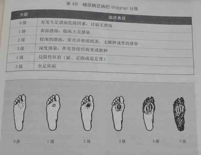 糖尿病足算残疾吗：其治疗、残疾评级、疾病分类及医疗范围解析