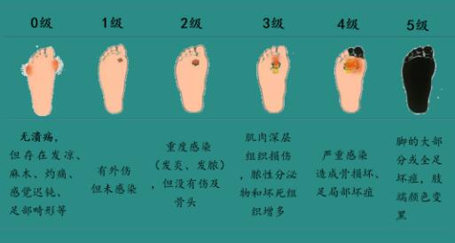 糖尿病足患者如何申请病退：详解病退条件与流程