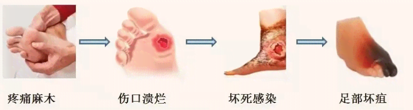 糖尿病足患者如何申请病退：详解病退条件与流程