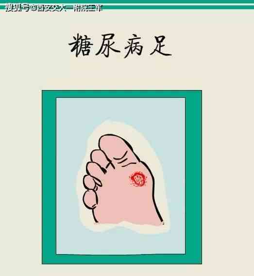 糖尿病足能认定工伤吗