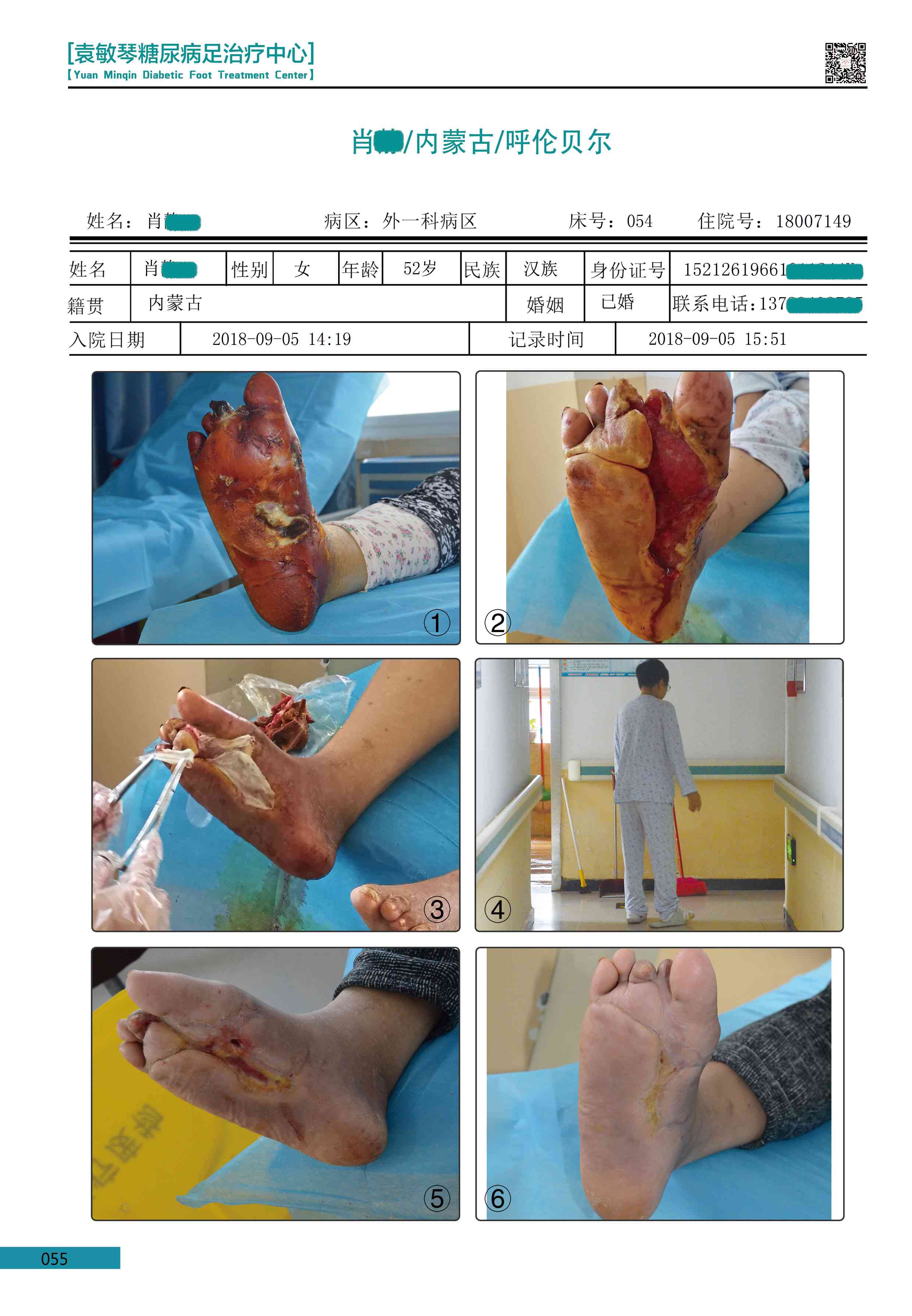 糖尿病足能认定工伤吗