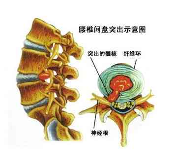 腰椎纤维环断裂能否认定为工伤及工伤赔偿标准解析