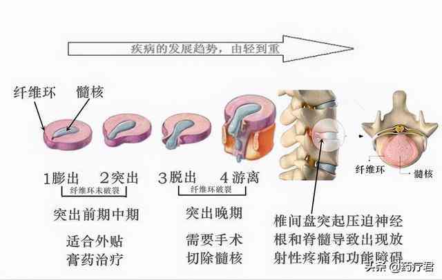 腰椎纤维环断裂能否认定为工伤及工伤赔偿标准解析