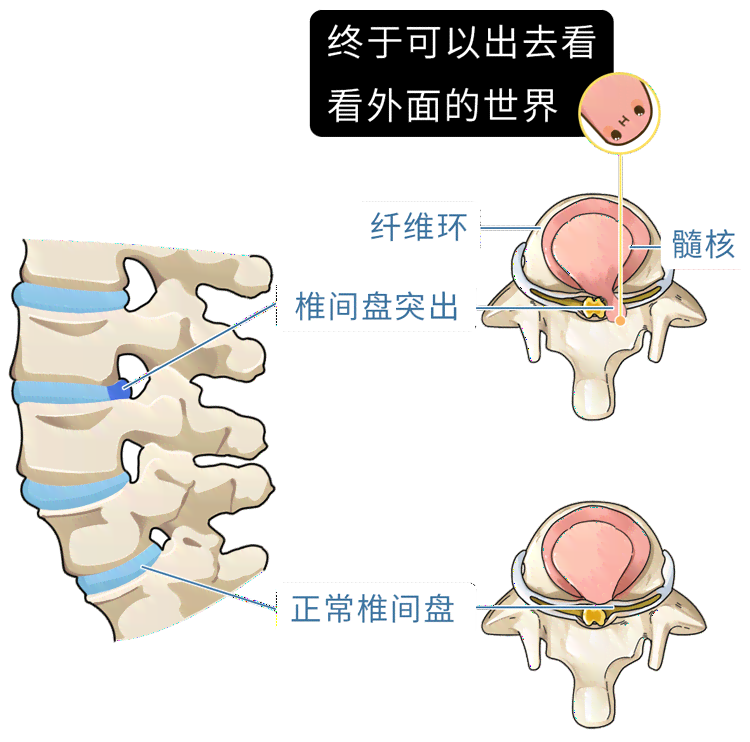 腰椎纤维环断裂能否认定为工伤及工伤赔偿标准解析