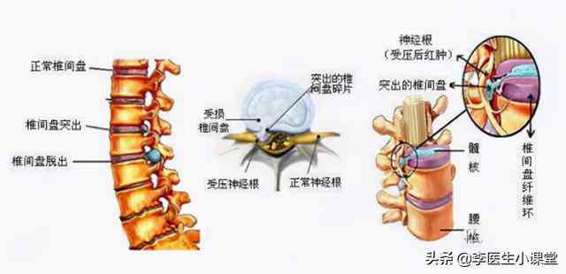 纤维环断裂有影响吗：女性如何治疗，能否恢复及其严重性探讨