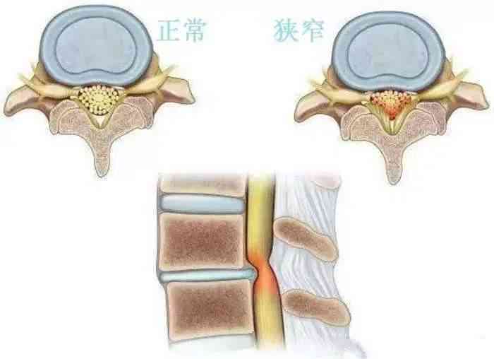 纤维环断裂有影响吗：女性如何治疗，能否恢复及其严重性探讨