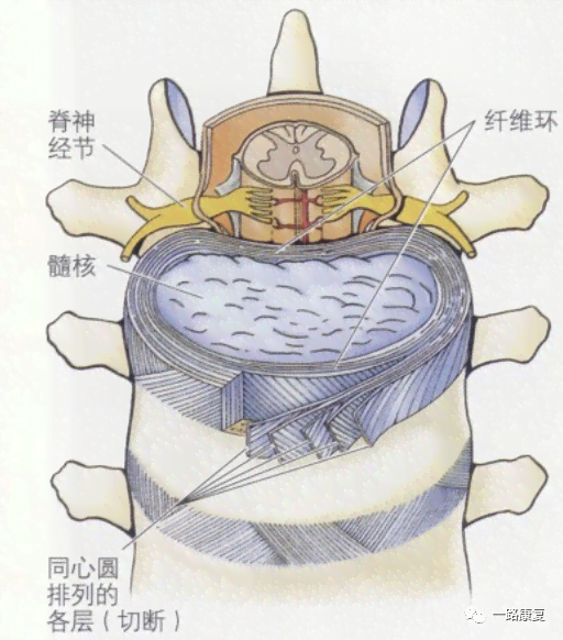 纤维环断裂可以认定工伤吗