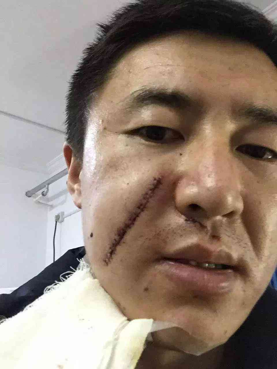 工伤认定标准详解：缝十一针是否构成工伤及如何申请工伤赔偿