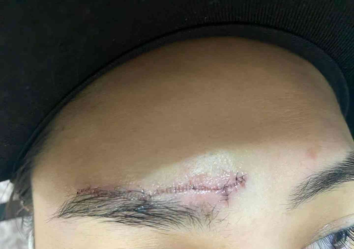 疑问：缝针十一针究竟属于何种伤害？探讨伤口严重程度与处理方法