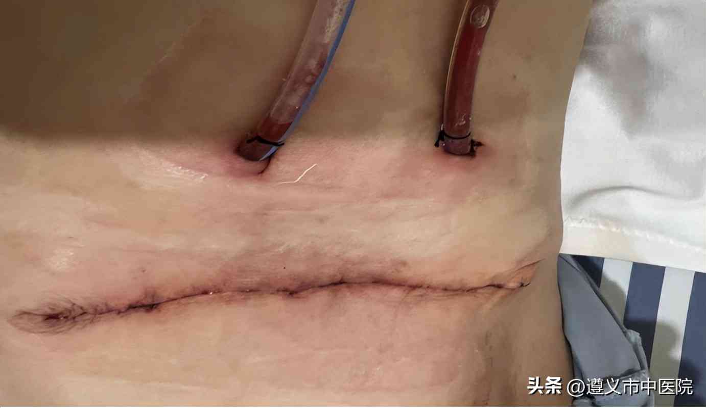 疑问：缝针十一针究竟属于何种伤害？探讨伤口严重程度与处理方法