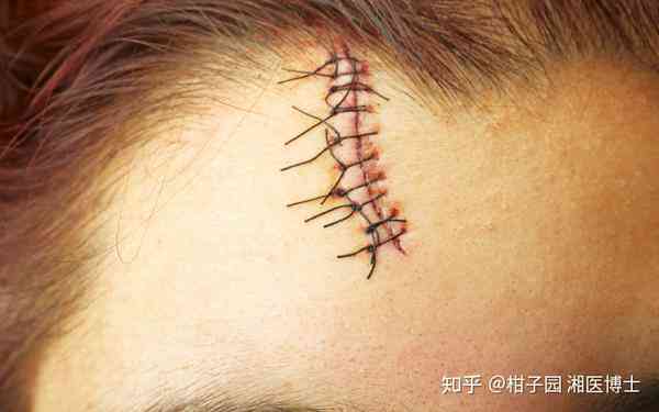 疑问：缝针十一针究竟属于何种伤害？探讨伤口严重程度与处理方法