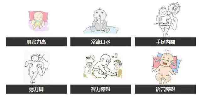 缺氧性脑病与脑瘫的关系解析：探究两者间的差异与联系
