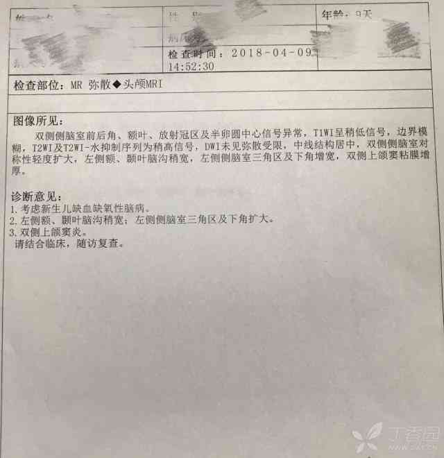 缺氧性脑病能认定工伤吗