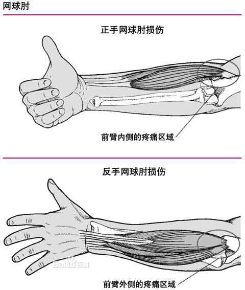 网球肘炎是否可达工伤认定及其伤残等级评估探讨
