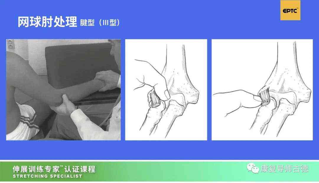 网球肘炎是否可达工伤认定及其伤残等级评估探讨