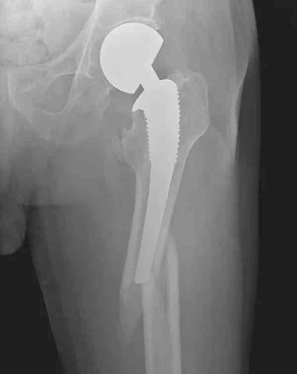 ai医学影像骨折分析报告模板：骨折医学影像学描述与报告撰写范例