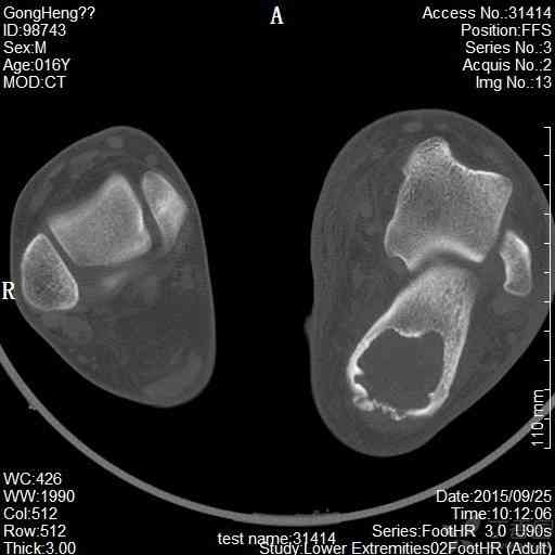 骨折医学影像诊断与评估：全面解析X光、CT、MRI在骨折诊断中的应用