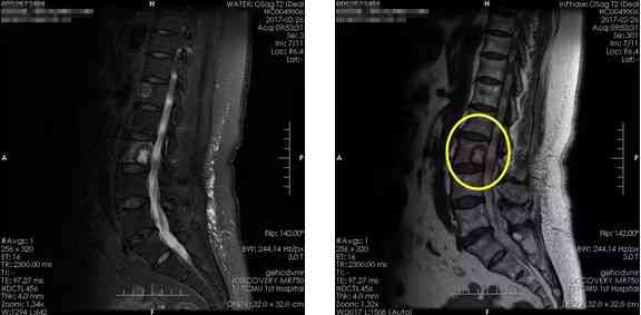 骨折医学影像诊断与评估：全面解析X光、CT、MRI在骨折诊断中的应用