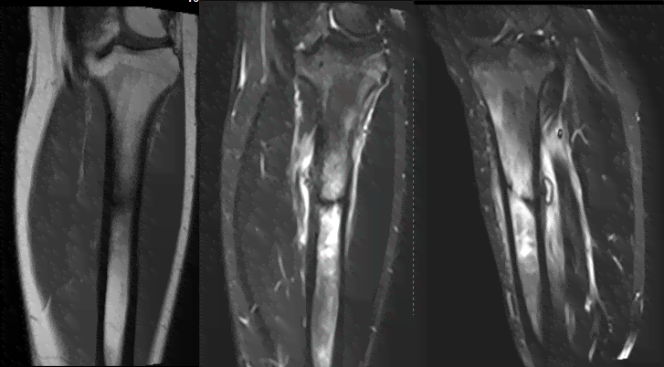 骨折医学影像诊断与评估：全面解析X光、CT、MRI在骨折诊断中的应用