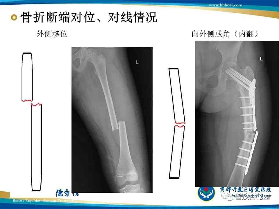 骨折诊断的影像学技术与进展解析