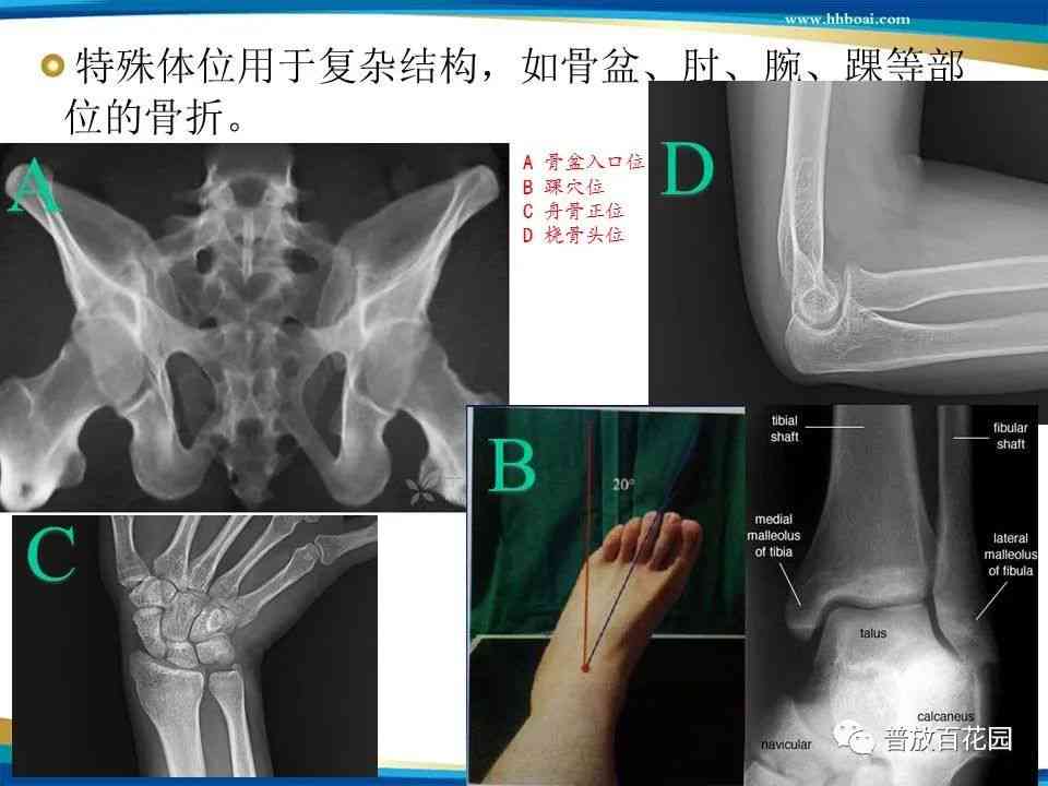 骨折诊断的影像学技术与进展解析