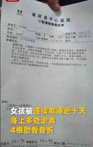 工伤评定：肋骨骨折导致的工伤等级划分详解