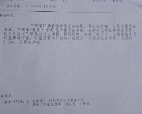工伤评定标准：肋骨骨折如何确定工伤伤残等级