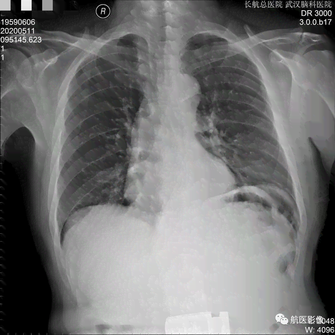 肋骨骨折是否可被认定为工伤情形