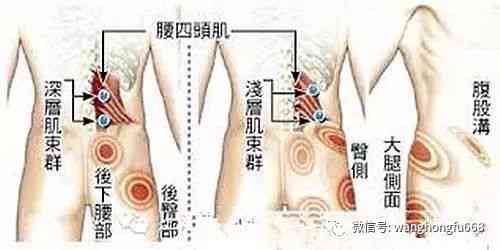 慢性肌筋膜炎：日常劳动能力受影响程度解析