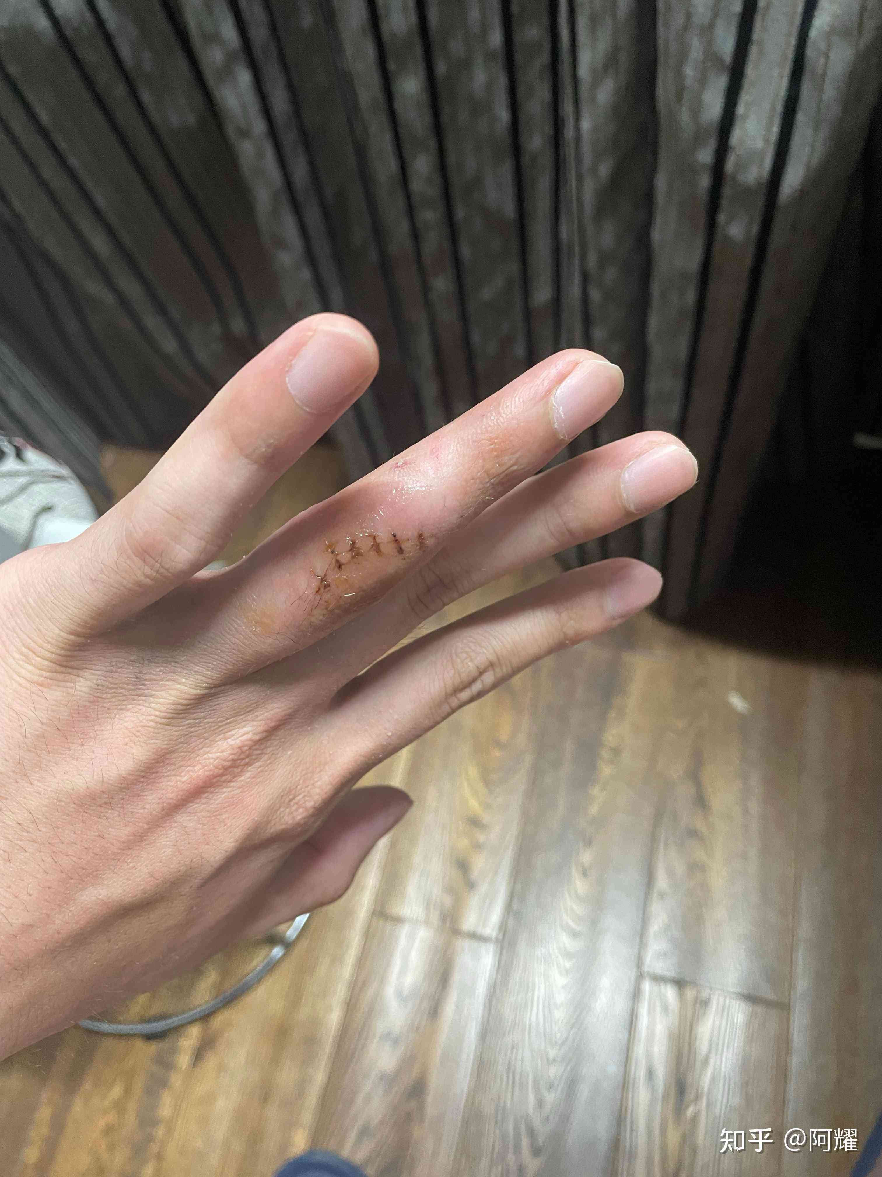 肌腱断裂能认定工伤吗