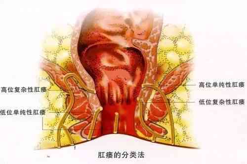 肛瘘可以认定工伤吗