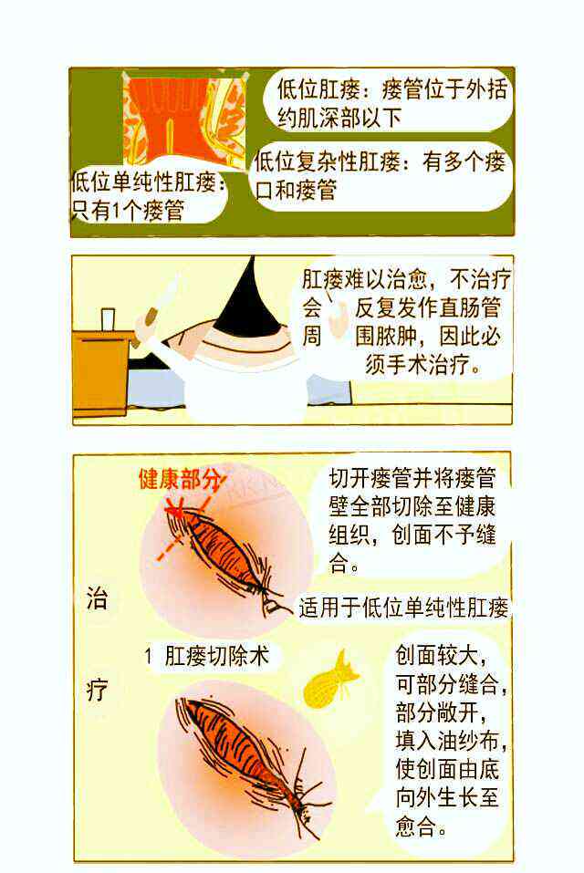 肛瘘可以认定工伤吗