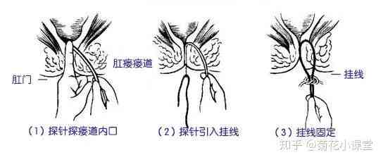 探讨肛瘘病症是否适用于工伤认定标准