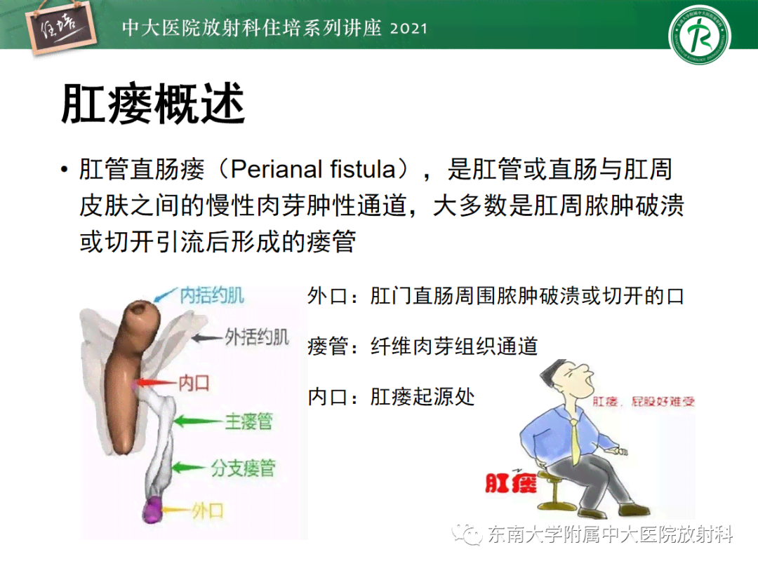 肛瘘患者能否申请残疾评定：全面解读评残标准与流程