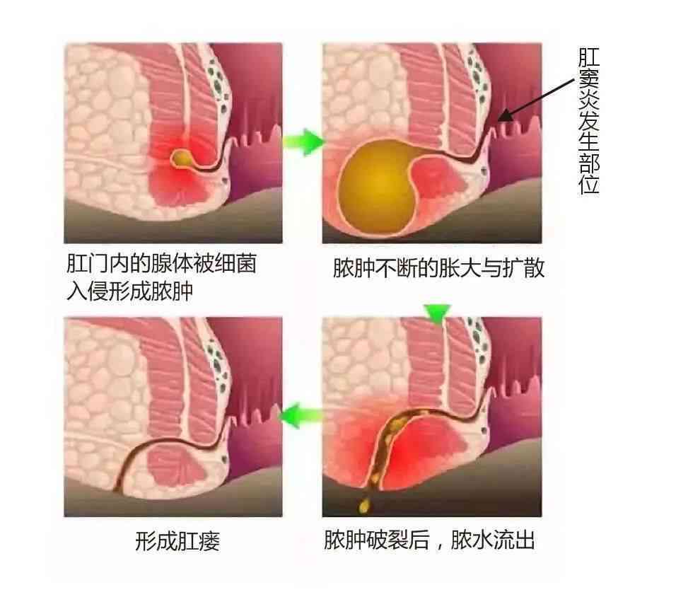 工伤认定：肛瘘病症是否属于职业病症范畴？